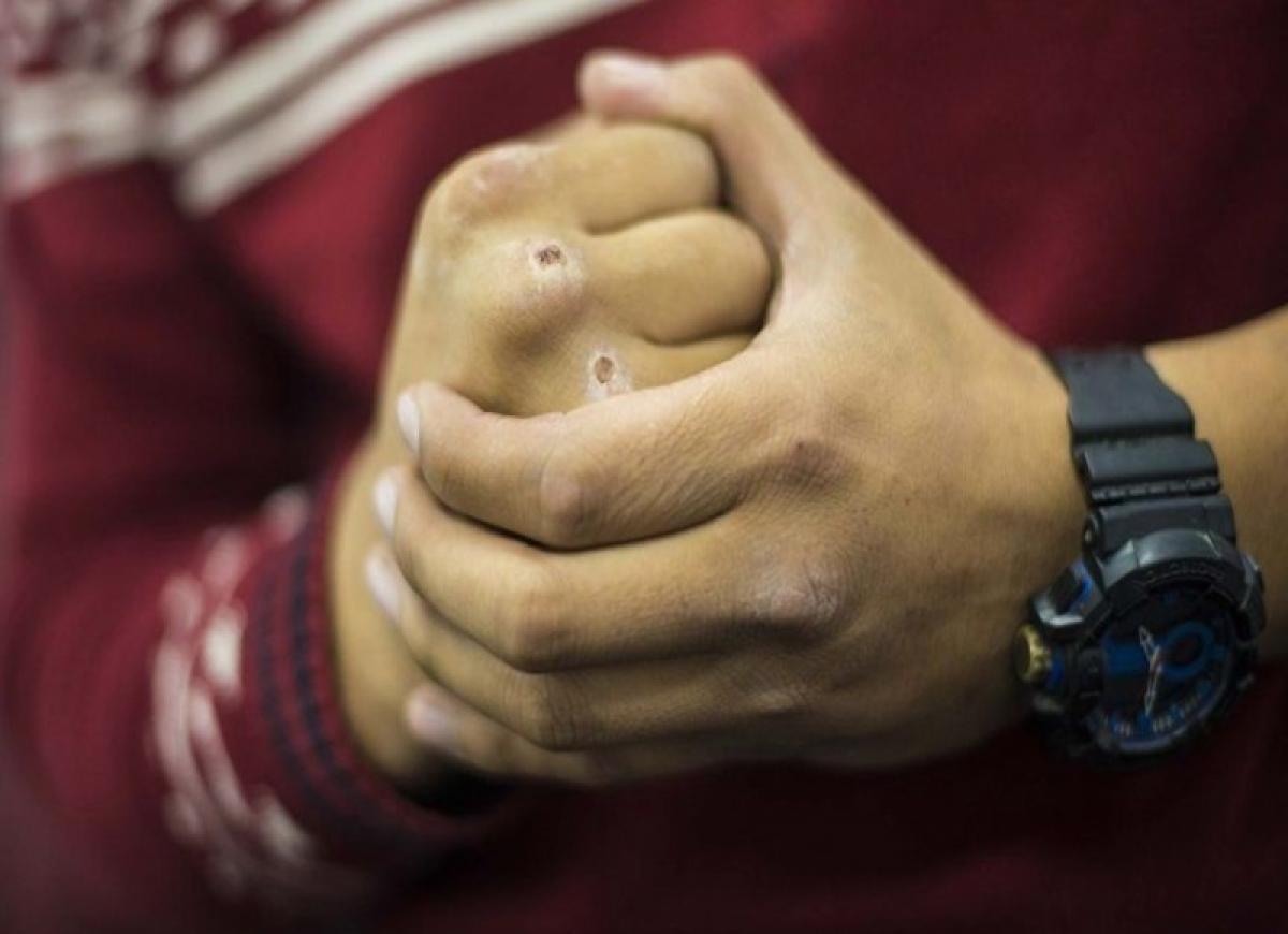 Подростки до потери сознания избили ребенка с ДЦП, вытершегося чужим полотенцем