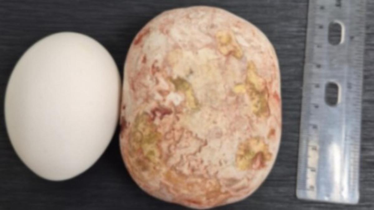 Саратовские хирурги удалили килограммовый камень 65-летнему пациенту 